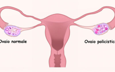 PCOS e dieta