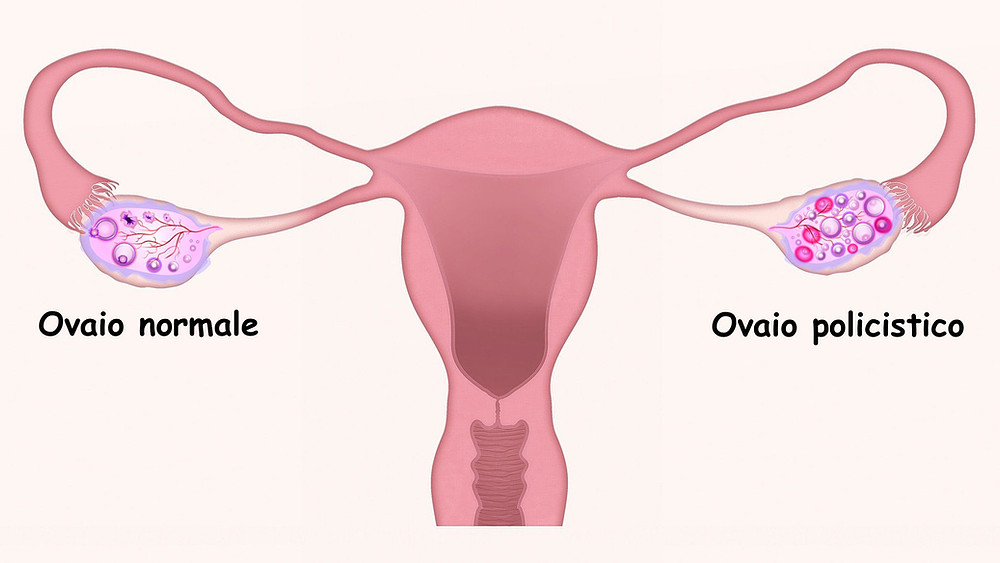 PCOS e dieta