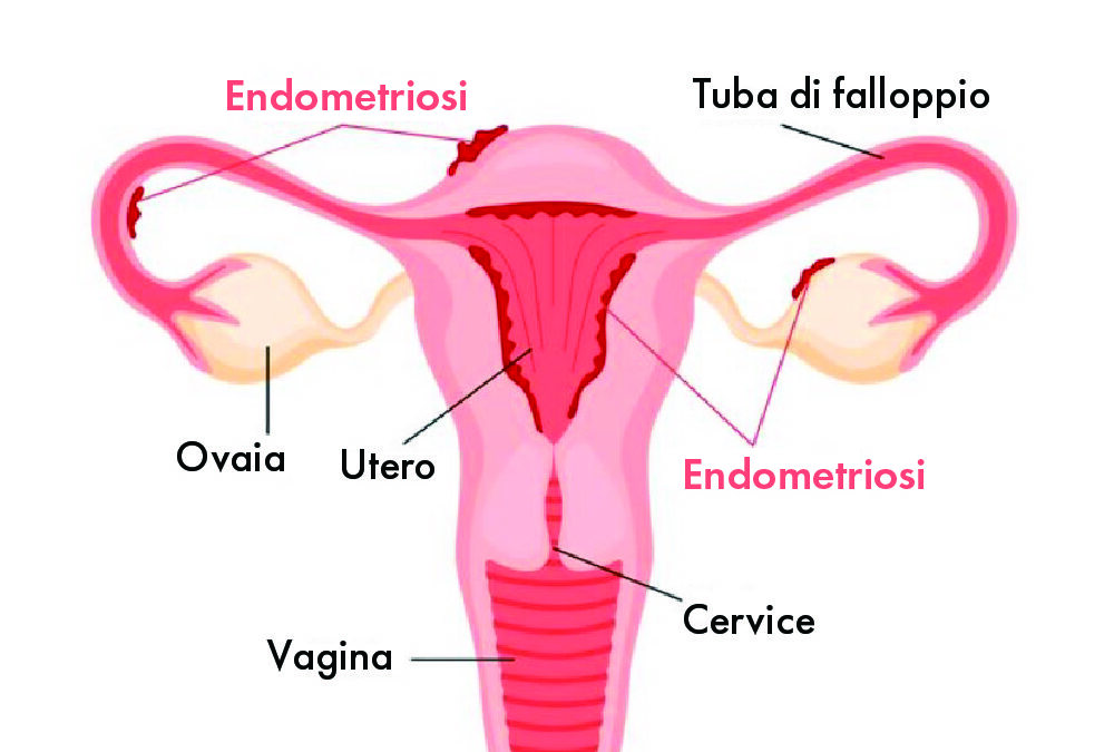 Endometriosi e glutine