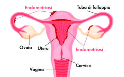 Endometriosi e glutine